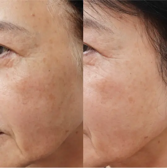 顔広範囲の肝斑含む色素沈着の症例1